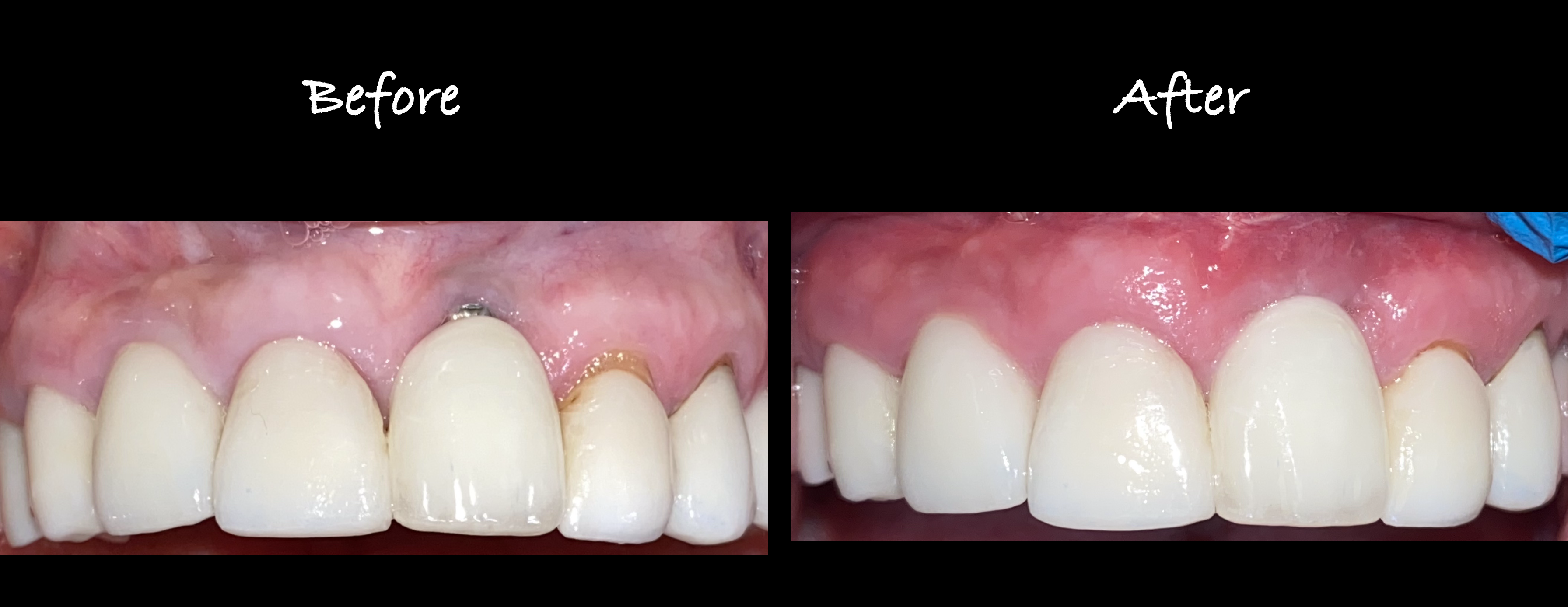 Gum Graft for Implant Case 1